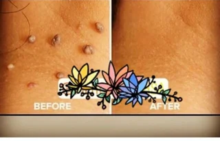 برداشتن خال و زیگیل و منگوله گوشتی در منزل