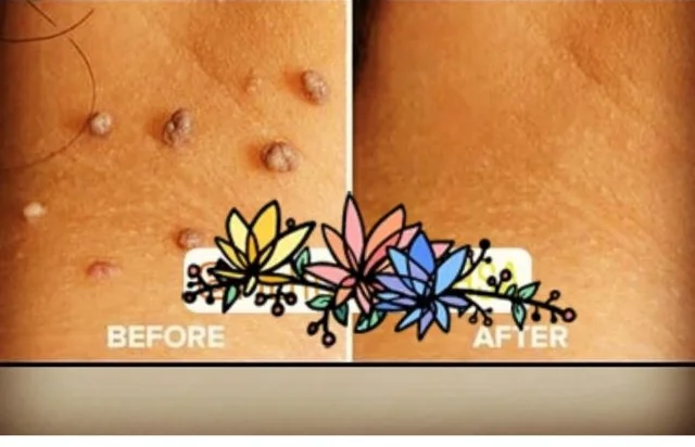 برداشتن خال و زیگیل و منگوله گوشتی در منزل